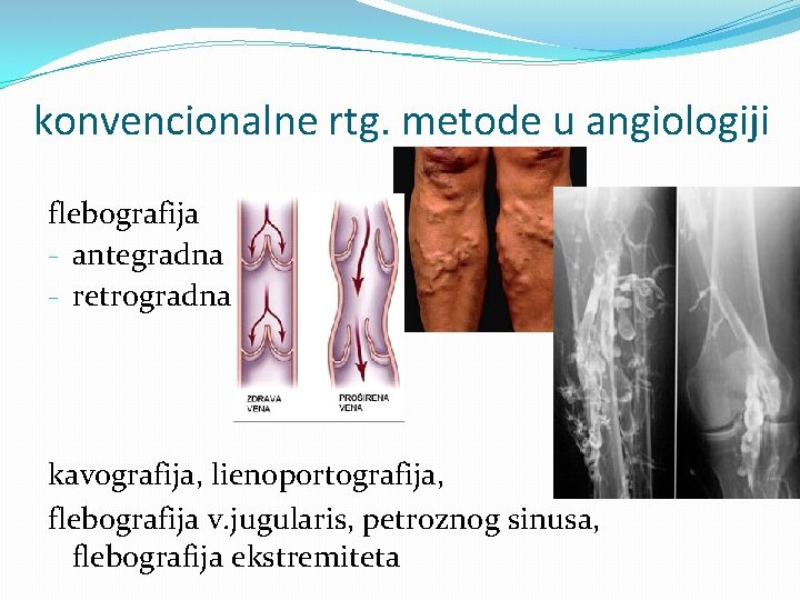 konvencionalne rtg. metode u angiologiji flebografija - antegradna - retrogradna kavografija, lienoportografija, flebografija v.