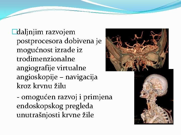 �daljnjim razvojem postprocesora dobivena je mogućnost izrade iz trodimenzionalne angiografije virtualne angioskopije – navigacija