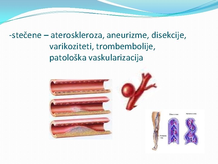 -stečene – ateroskleroza, aneurizme, disekcije, varikoziteti, trombembolije, patološka vaskularizacija 