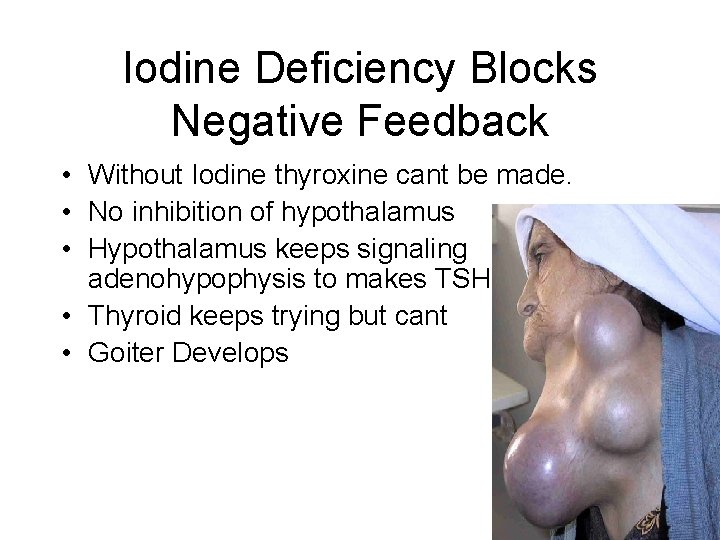 Iodine Deficiency Blocks Negative Feedback • Without Iodine thyroxine cant be made. • No