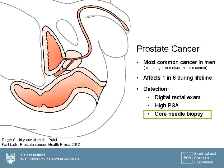 Prostate Cancer • Most common cancer in men (excluding non-melanoma skin cancer) • Affects