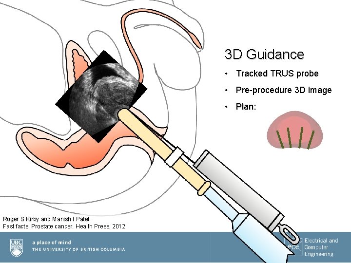 3 D Guidance • Tracked TRUS probe • Pre-procedure 3 D image • Plan: