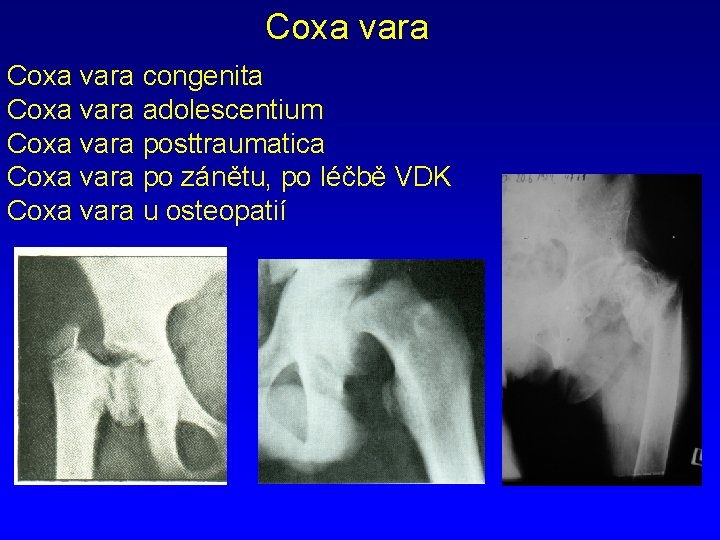 Coxa vara congenita Coxa vara adolescentium Coxa vara posttraumatica Coxa vara po zánětu, po