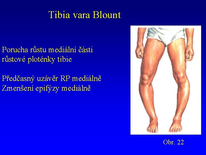 Tibia vara Blount Porucha růstu mediální části růstové ploténky tibie Předčasný uzávěr RP mediálně