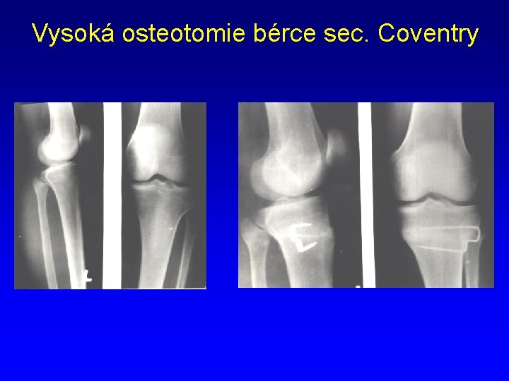 Vysoká osteotomie bérce sec. Coventry 