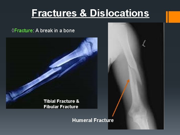 Fractures & Dislocations ◊Fracture: A break in a bone Tibial Fracture & Fibular Fracture