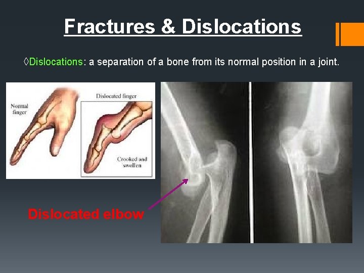 Fractures & Dislocations ◊Dislocations: a separation of a bone from its normal position in