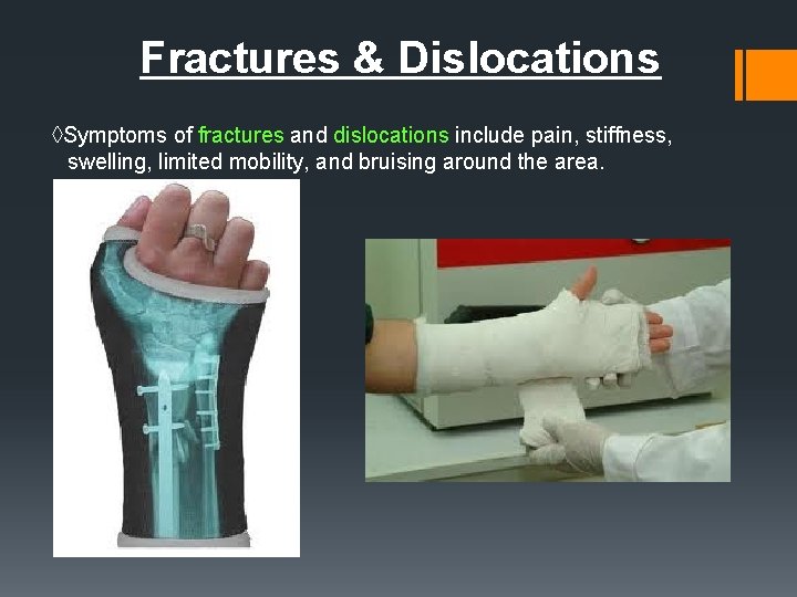 Fractures & Dislocations ◊Symptoms of fractures and dislocations include pain, stiffness, swelling, limited mobility,