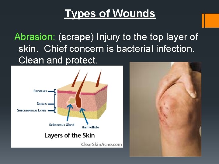 Types of Wounds Abrasion: (scrape) Injury to the top layer of skin. Chief concern