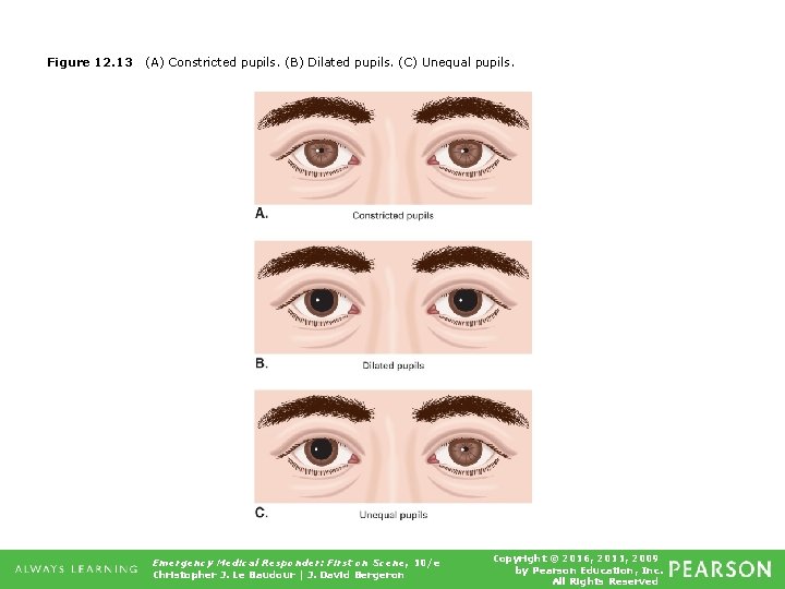 Figure 12. 13 (A) Constricted pupils. (B) Dilated pupils. (C) Unequal pupils. Emergency Medical