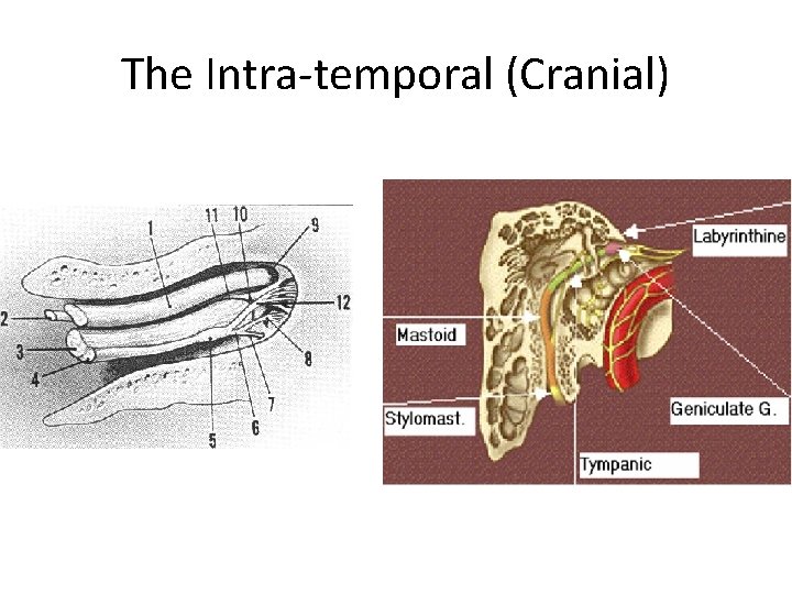 The Intra-temporal (Cranial) 