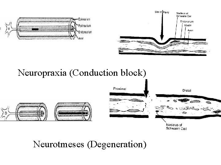 Neuropraxia (Conduction block) Neurotmeses (Degeneration) 
