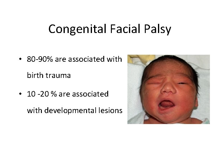 Congenital Facial Palsy • 80 -90% are associated with birth trauma • 10 -20