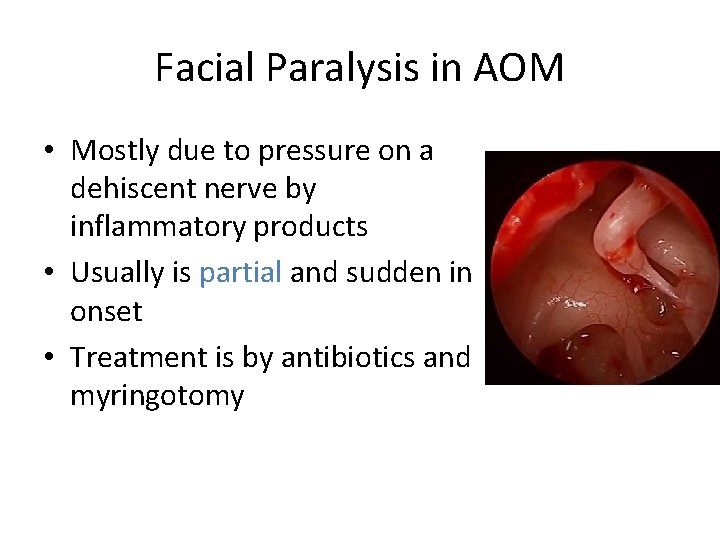 Facial Paralysis in AOM • Mostly due to pressure on a dehiscent nerve by