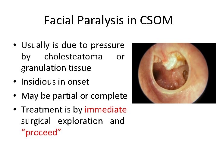 Facial Paralysis in CSOM • Usually is due to pressure by cholesteatoma or granulation
