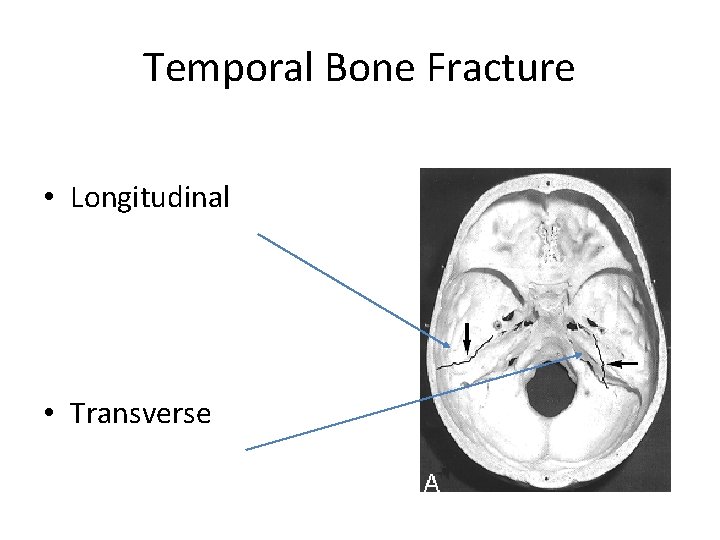 Temporal Bone Fracture • Longitudinal • Transverse 