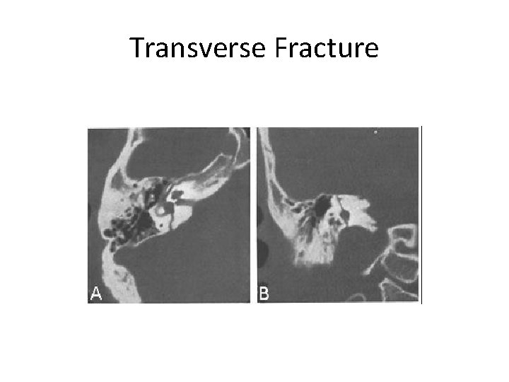 Transverse Fracture 