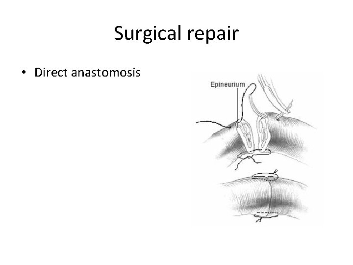 Surgical repair • Direct anastomosis 