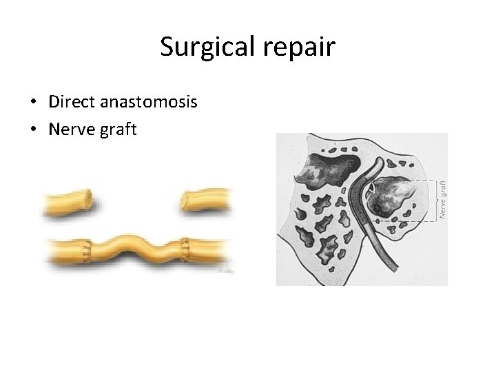 Surgical repair • Direct anastomosis • Nerve graft 