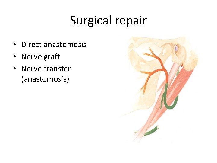Surgical repair • Direct anastomosis • Nerve graft • Nerve transfer (anastomosis) 