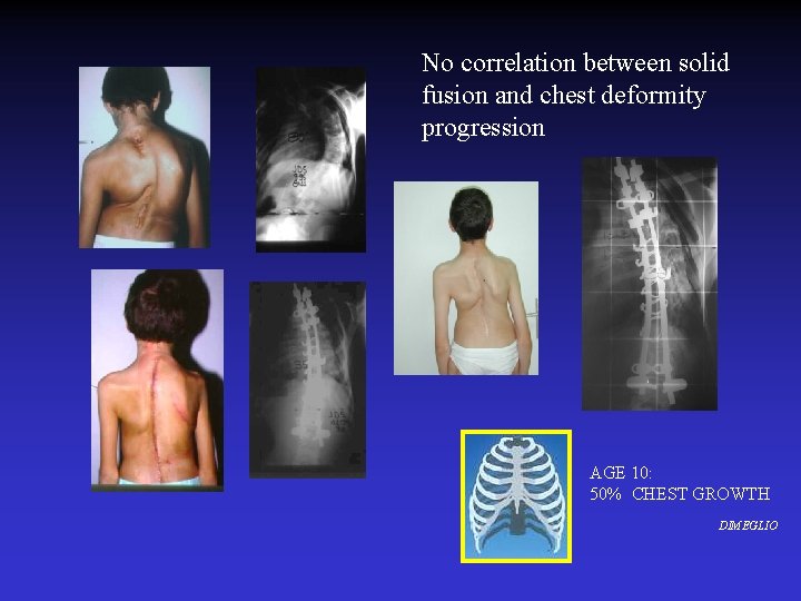 No correlation between solid fusion and chest deformity progression AGE 10: 50% CHEST GROWTH