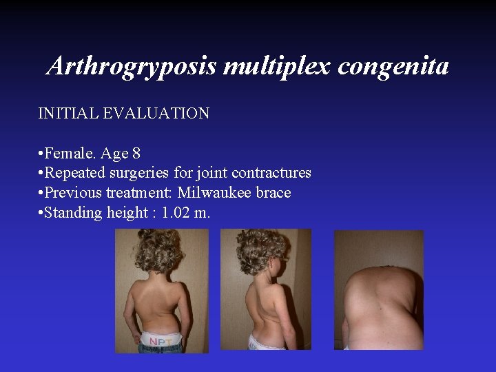 Arthrogryposis multiplex congenita INITIAL EVALUATION • Female. Age 8 • Repeated surgeries for joint