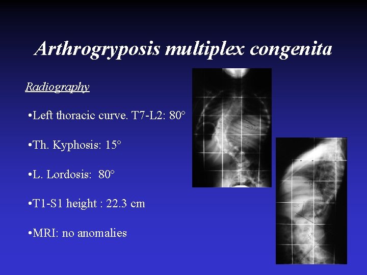 Arthrogryposis multiplex congenita Radiography • Left thoracic curve. T 7 -L 2: 80º •