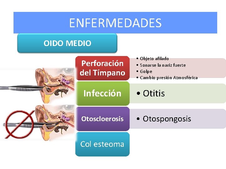 ENFERMEDADES OIDO MEDIO Perforación del Tímpano • • Objeto afilado Sonarse la nariz fuerte