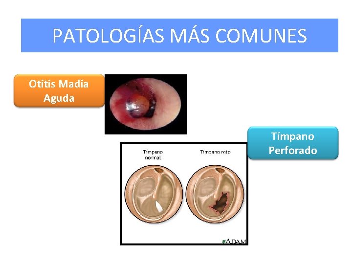 PATOLOGÍAS MÁS COMUNES Otitis Madia Aguda Tímpano Perforado 