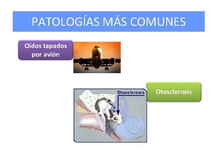 PATOLOGÍAS MÁS COMUNES Oídos tapados por avión Otosclerosis 