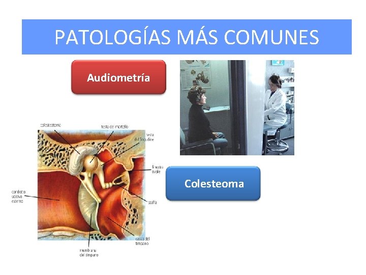 PATOLOGÍAS MÁS COMUNES Audiometría Colesteoma 
