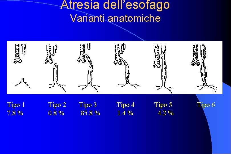 Atresia dell’esofago Varianti anatomiche Tipo 1 7. 8 % Tipo 2 0. 8 %