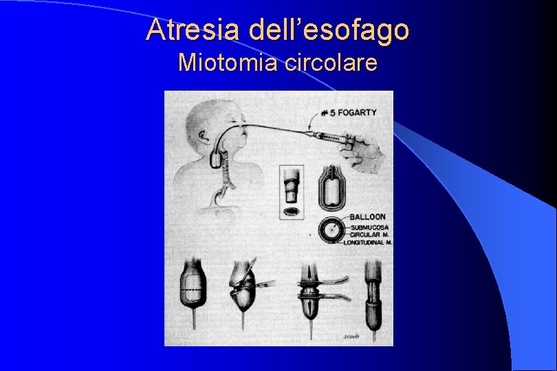 Atresia dell’esofago Miotomia circolare 