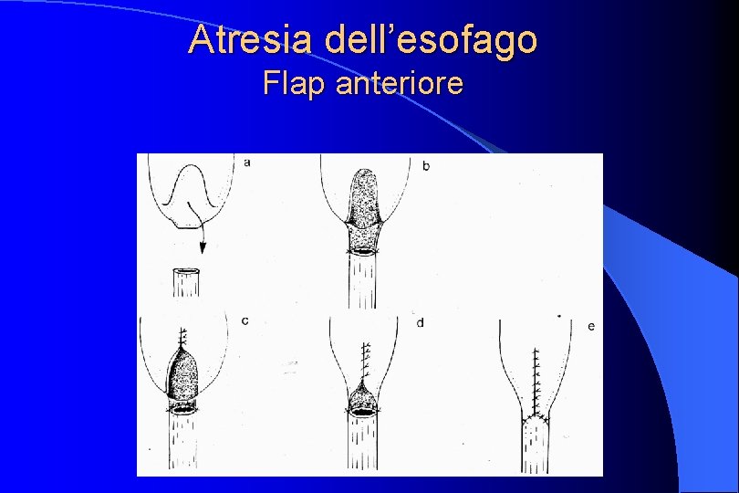 Atresia dell’esofago Flap anteriore 