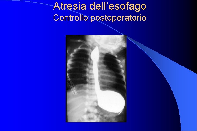 Atresia dell’esofago Controllo postoperatorio 