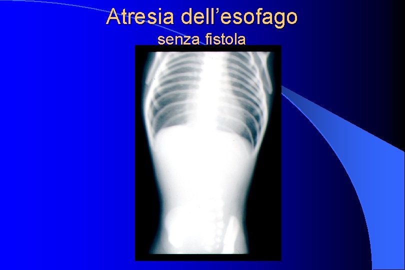 Atresia dell’esofago senza fistola 