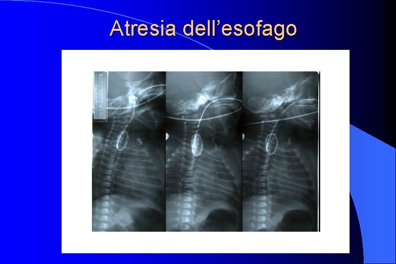 Atresia dell’esofago 