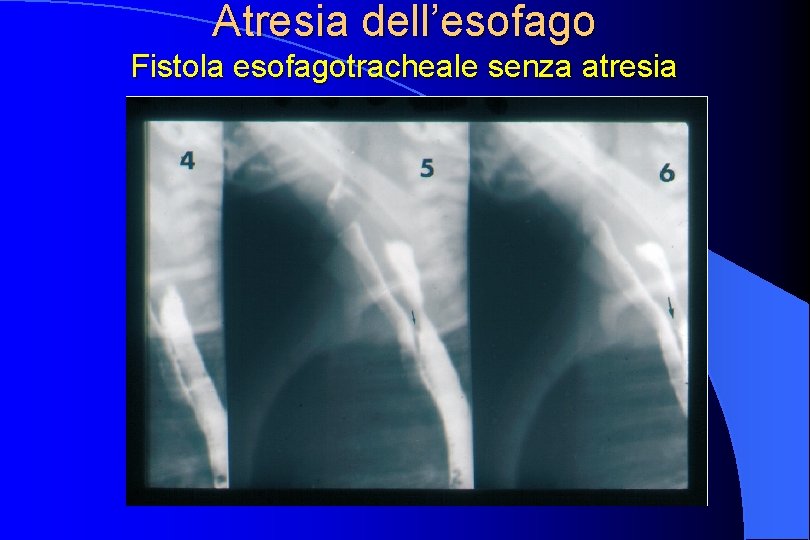 Atresia dell’esofago Fistola esofagotracheale senza atresia 