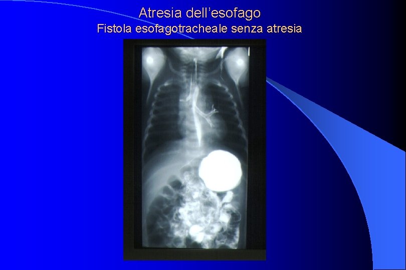 Atresia dell’esofago Fistola esofagotracheale senza atresia 