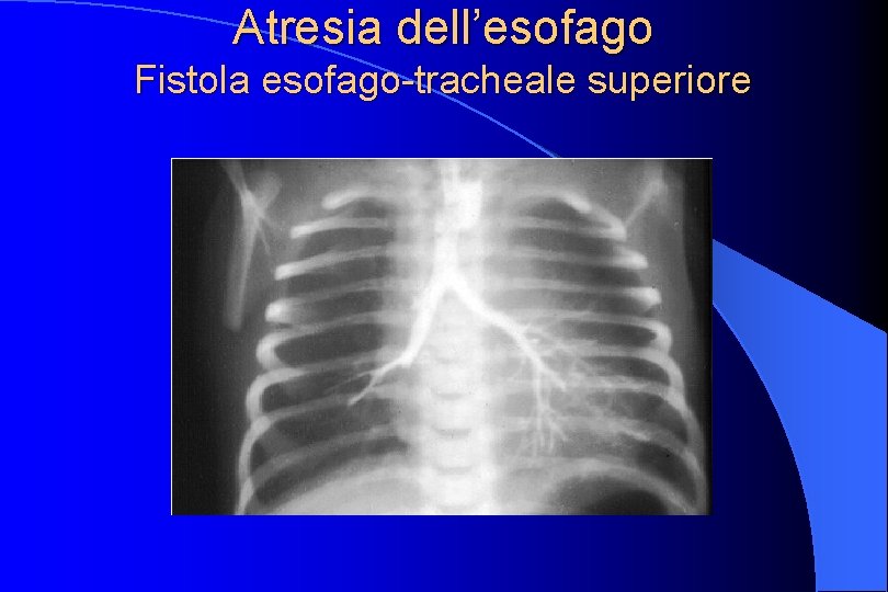 Atresia dell’esofago Fistola esofago-tracheale superiore 