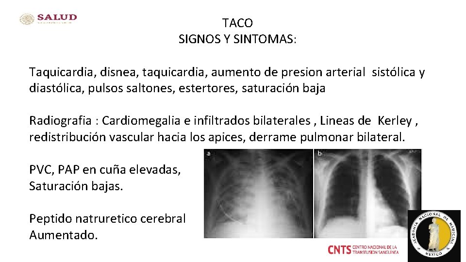 TACO SIGNOS Y SINTOMAS: Taquicardia, disnea, taquicardia, aumento de presion arterial sistólica y diastólica,