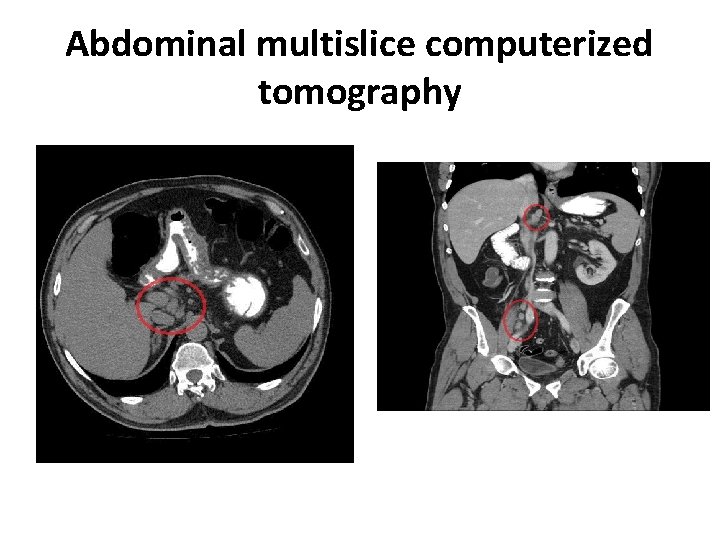 Abdominal multislice computerized tomography 