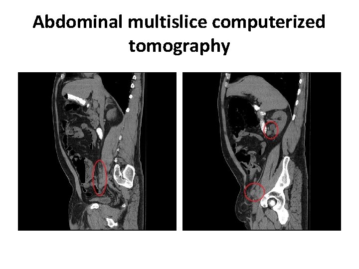 Abdominal multislice computerized tomography 