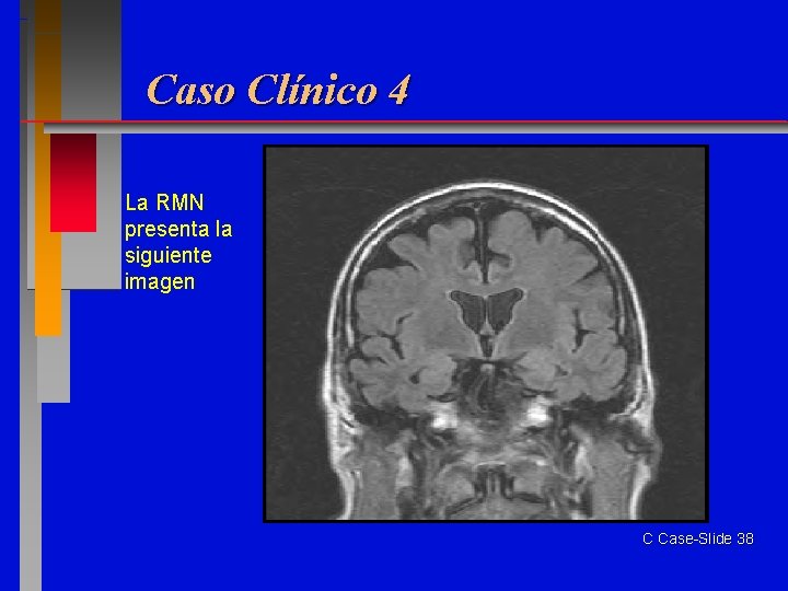 Caso Clínico 4 La RMN presenta la siguiente imagen C Case-Slide 38 