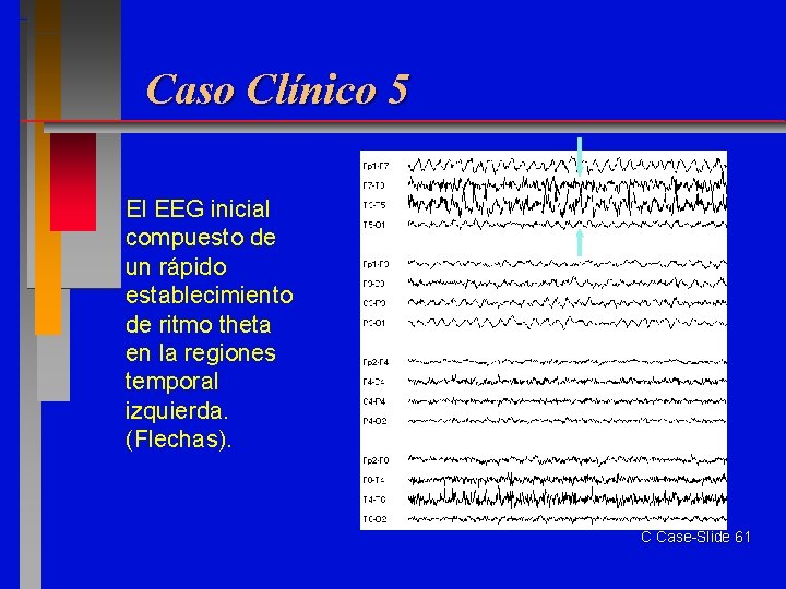 Caso Clínico 5 El EEG inicial compuesto de un rápido establecimiento de ritmo theta