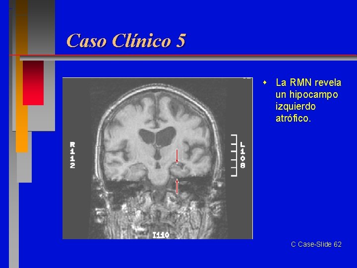 Caso Clínico 5 La RMN revela un hipocampo izquierdo atrófico. C Case-Slide 62 
