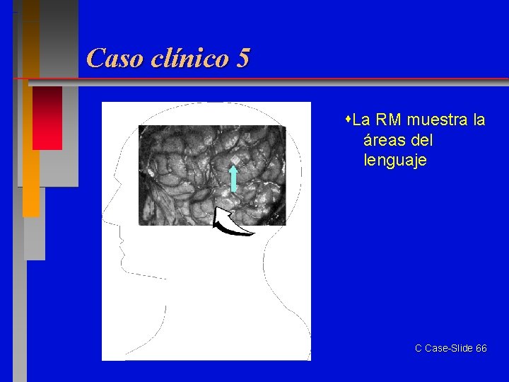 Caso clínico 5 La RM muestra la áreas del lenguaje C Case-Slide 66 