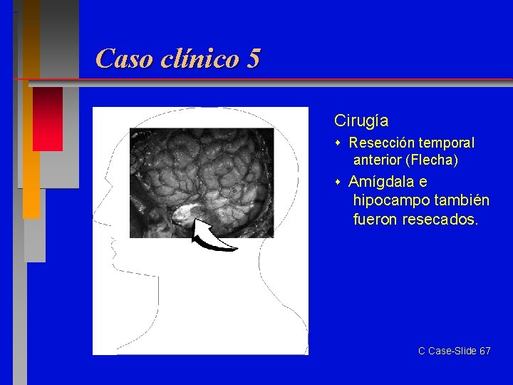 Caso clínico 5 Cirugía Resección temporal anterior (Flecha) Amígdala e hipocampo también fueron resecados.