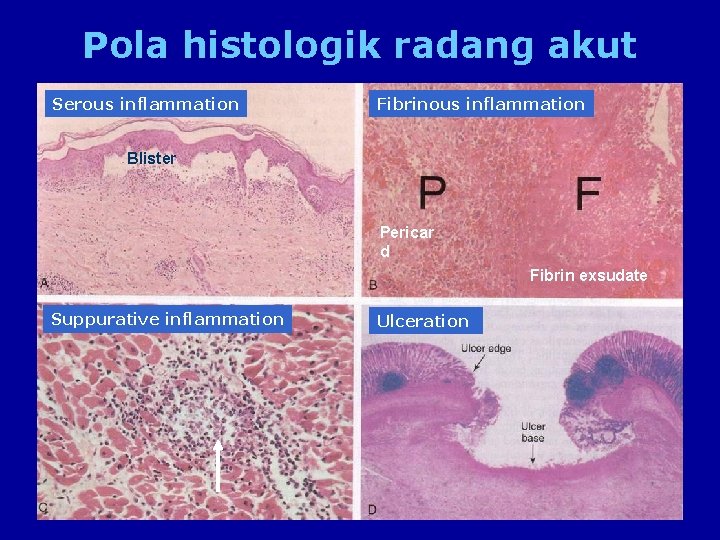 Pola histologik radang akut Serous inflammation Fibrinous inflammation Blister Pericar d Fibrin exsudate Suppurative