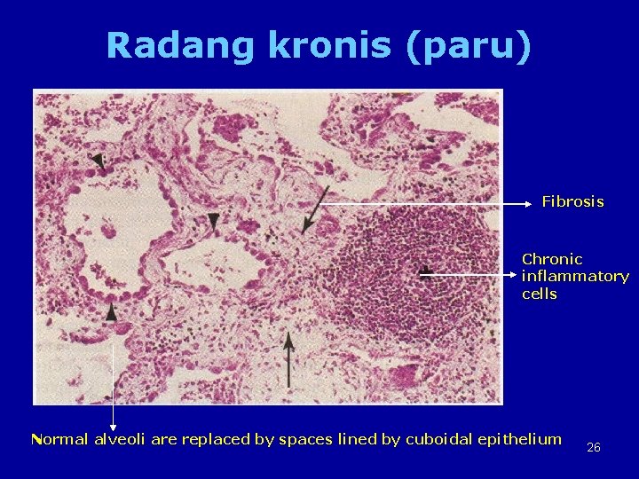 Radang kronis (paru) Fibrosis Chronic inflammatory cells Normal alveoli are replaced by spaces lined